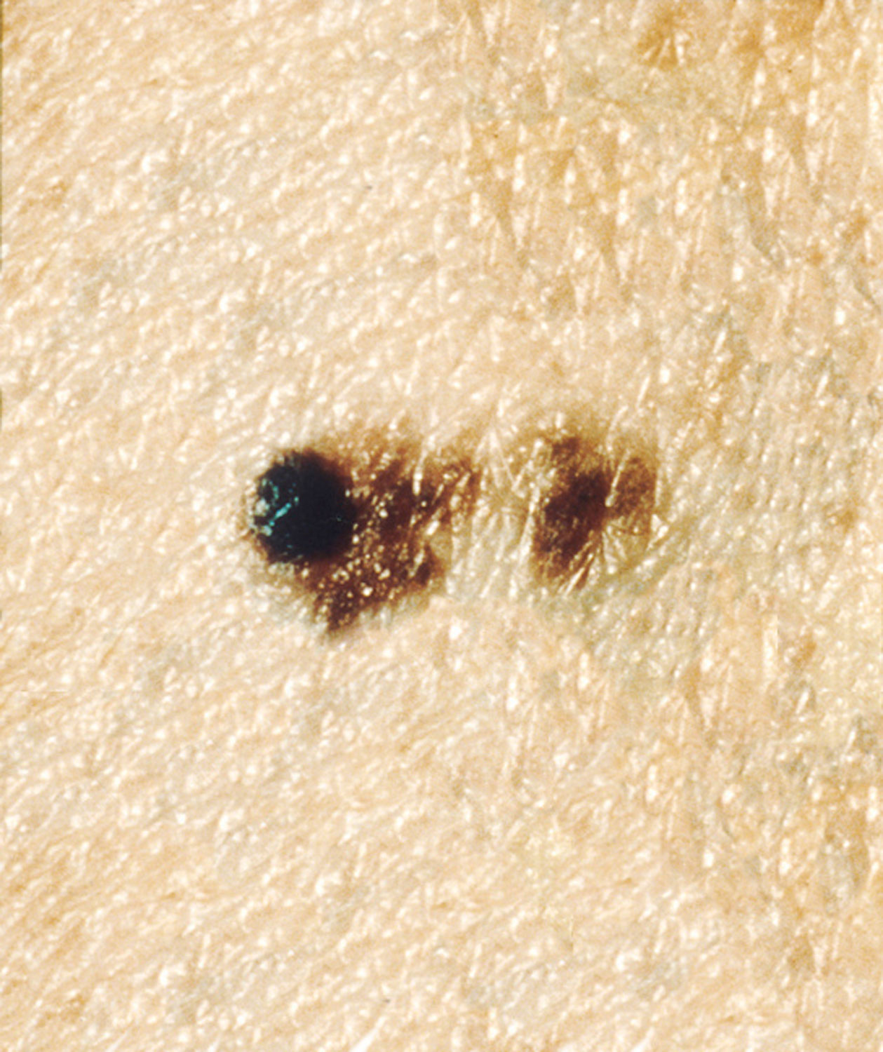 меланома кожи фото начальная