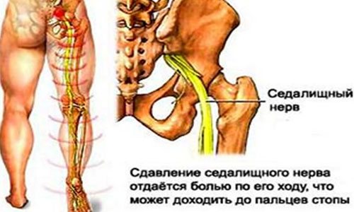 Где находится сидальческий нерв у человека фото и как лечить