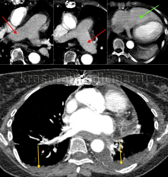 КТ ОГК С+. Расширение долевых легочных артерий (красные стрелки), расширение правого желудочка (зеленая стрелка), двухсторонний выпот в грудной полости (желтые стрелки) у пациентки с застойными явлениями в малом круге кровообращения