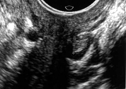 ТВУЗИ - в просвете расширенной вены слева от матки визуализируется тромб средней эхогенности