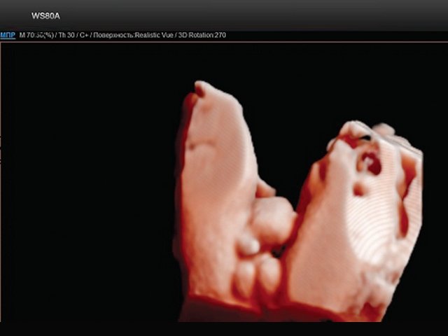 Эхограмма - экстрофия мочевого пузыря в сочетании с отсутствием видимой патологии наружных половых органов (режим 3D)