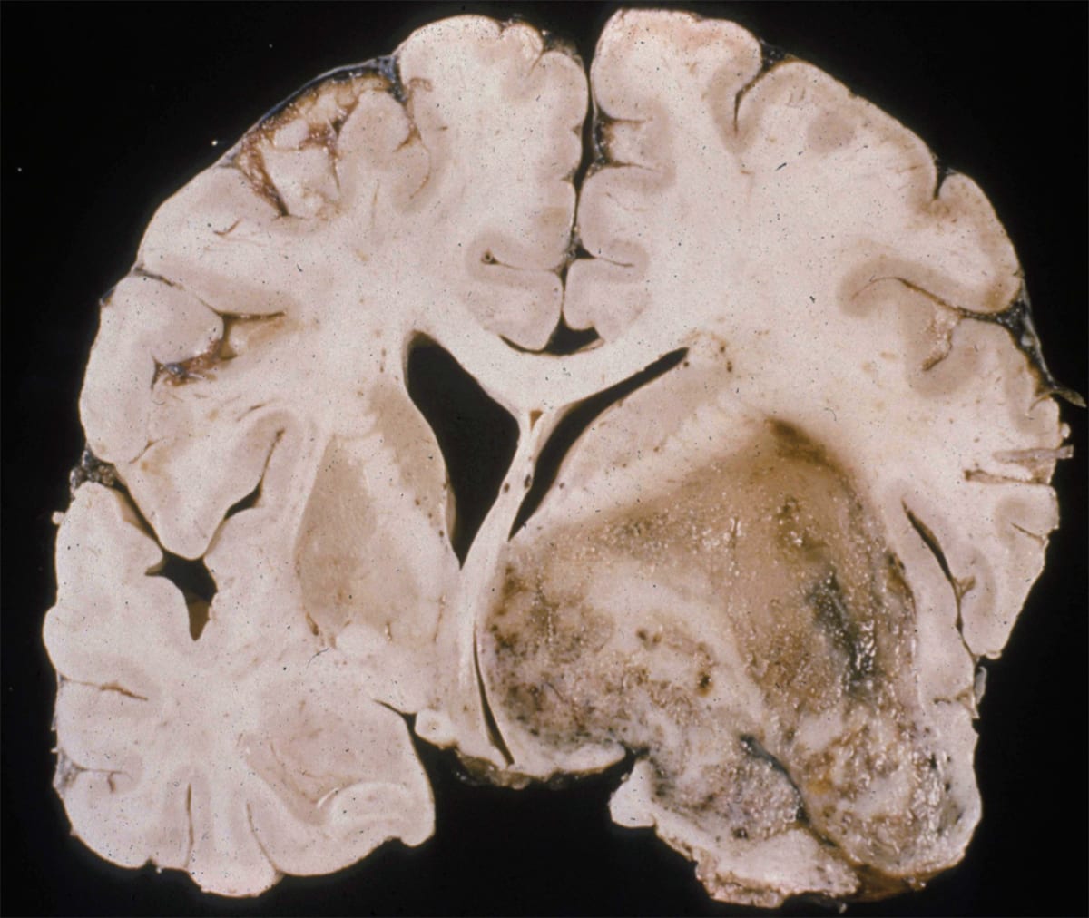 Опухоль головного мозга отек. Опухоль мозга глиобластома. Опухоль головного мозга макропрепарат. Миобластома головного мозга. Онкология глиобластома.