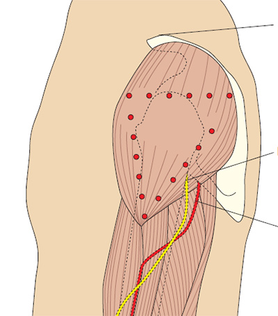 Дельтовидная мышца: места для внутримышечных инъекций