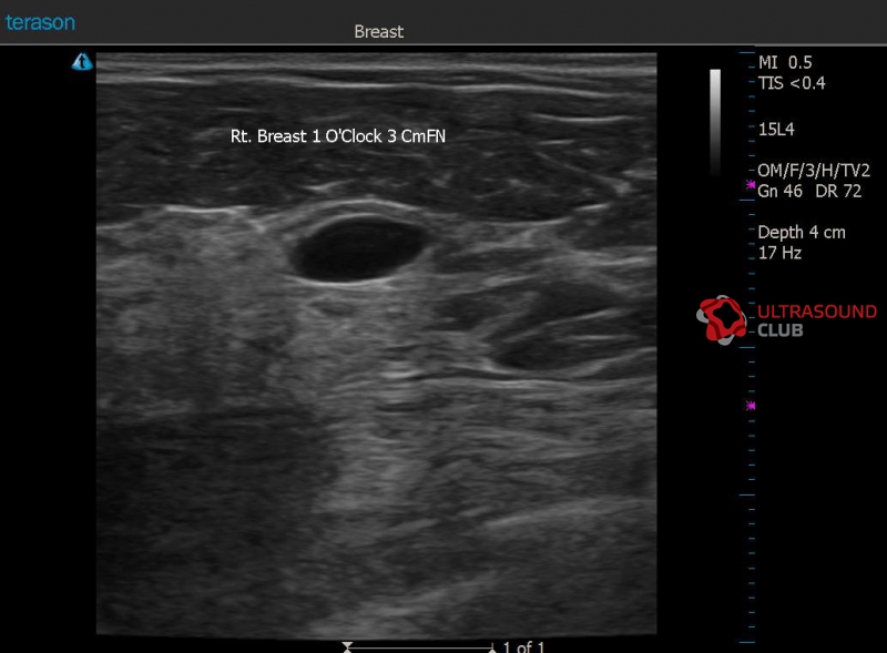 Кисты молочных желез что это. Протоковая киста молочной железы эхограммы. Протоковые кисты УЗИ молочной железы. 6мм киста молочной железы. Как выглядит киста молочной железы на УЗИ.