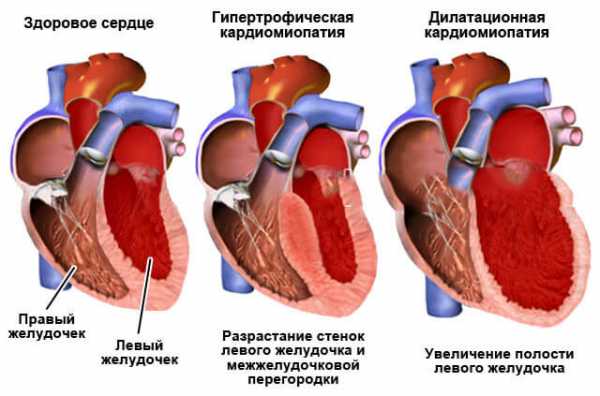 Желудочковая экстрасистолия на экг фото